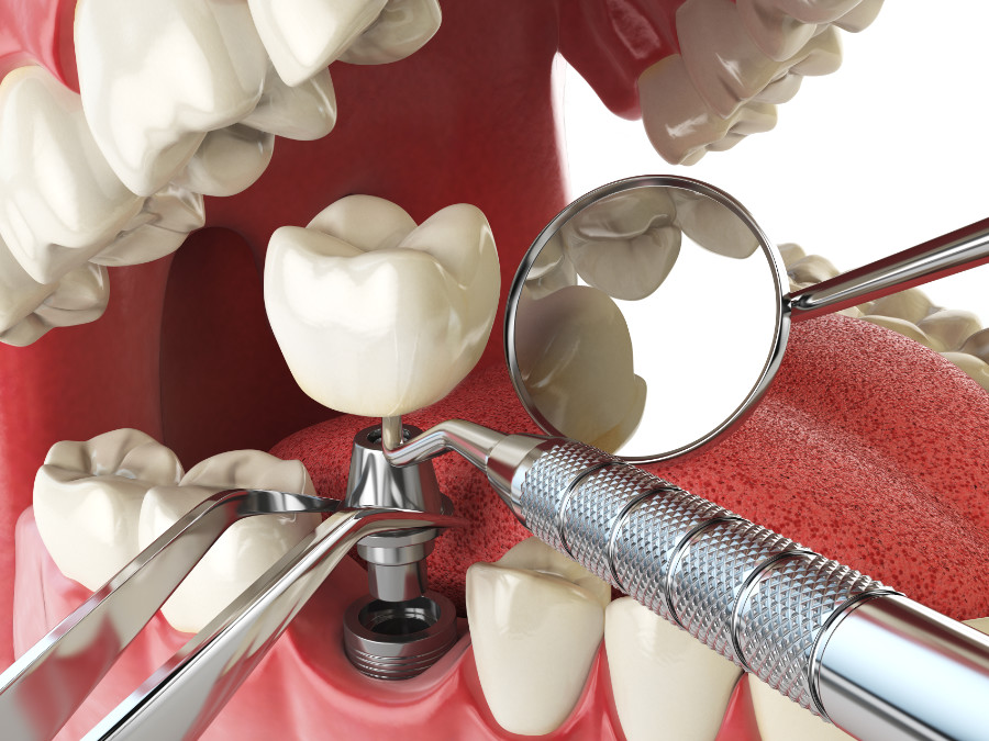  Behandlungsablauf bei Zahnimplantaten
